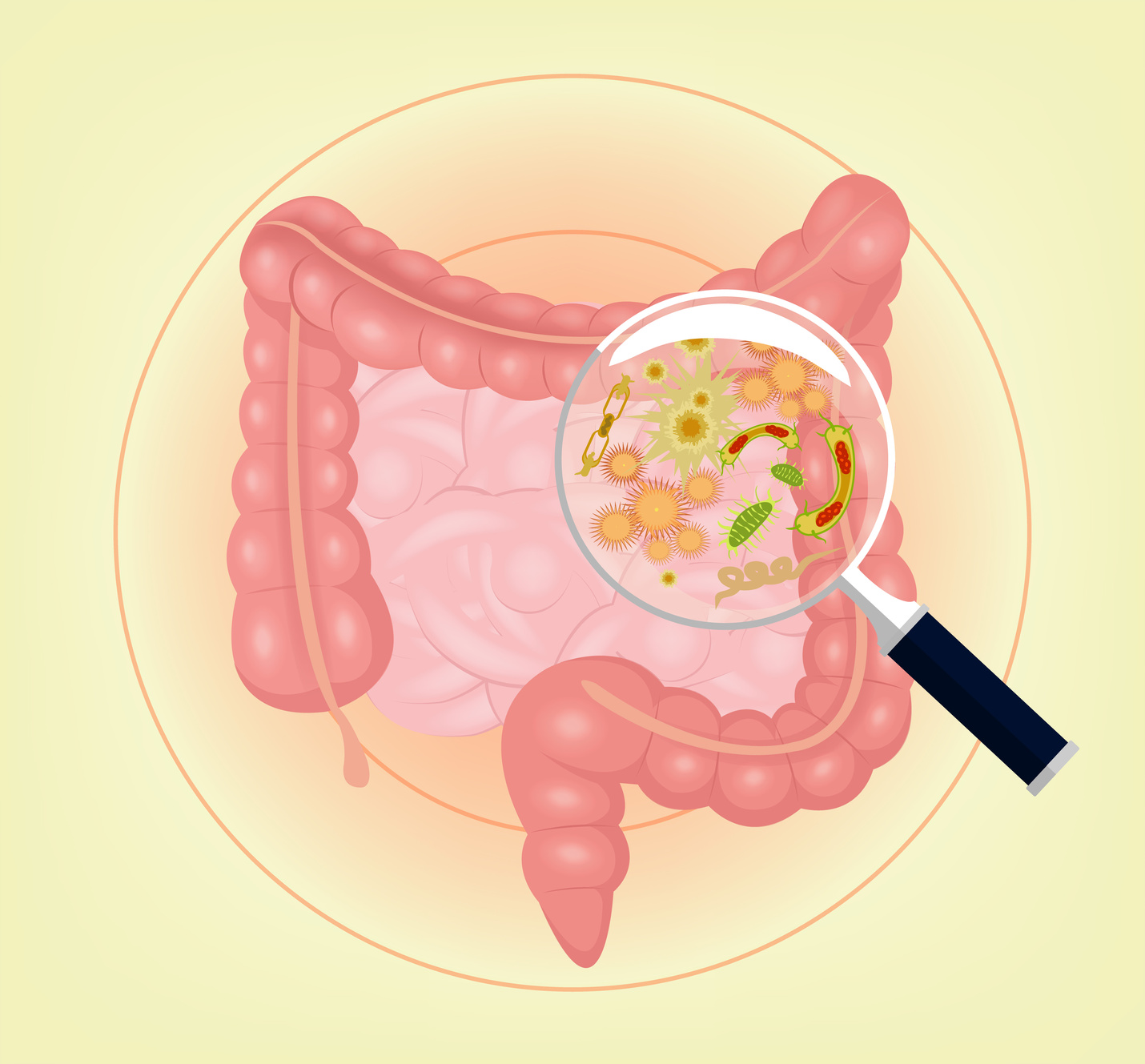 Qué es la enfermedad inflamatoria intestinal?